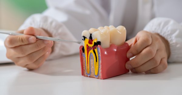 Affordable Options for a Root Canal in Grand Prairie