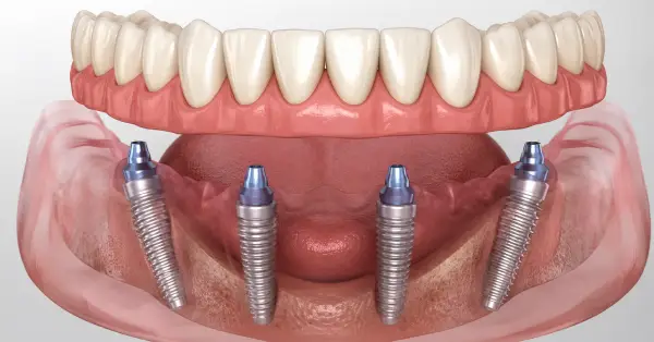 Helpful dental information about All On 4 dental implants in Grand Prairie