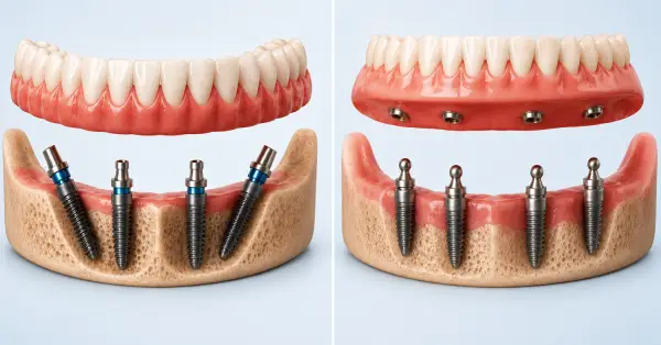 Helpful dental information about All-on-4 dental implants in Grand Prairie