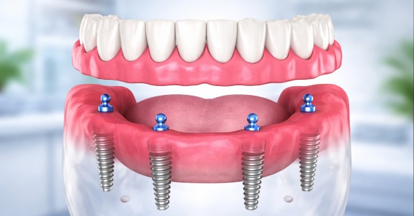 Dental implants in Grand Prairie illustration showing a straight-on view of an implant-supported lower denture secured with four dental implants and ball abutments.