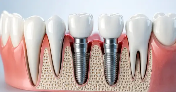 Helpful dental information about dental implants in Grand Prairie