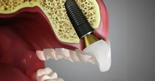 The Benefits of Dental Implants Over Other Tooth Replacement Options