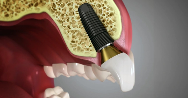 Different Types of Dental Implants