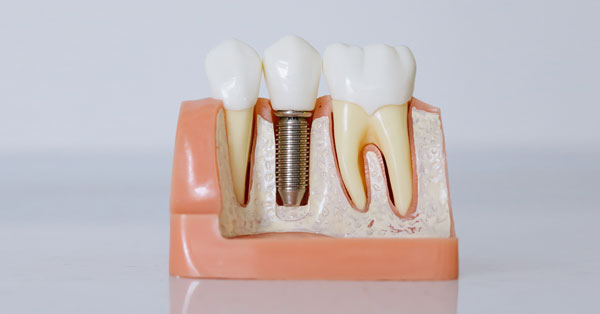 Expert Dental Implant Care Tips