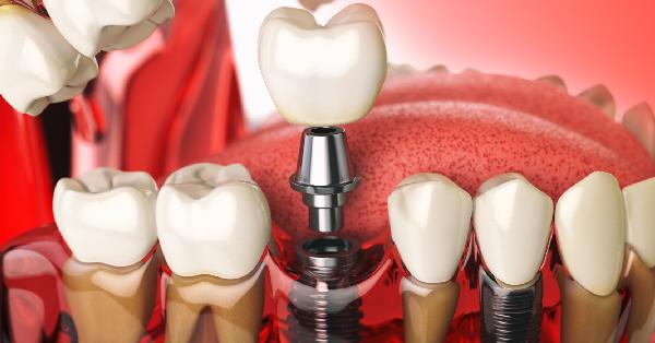 Explore the Top Benefits of Dental Implants in Grand Prairie