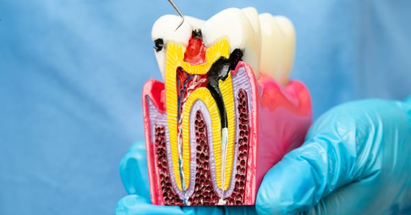 Exploring the Top 5 Types of Root Canals in Grand Prairie