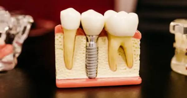 How to Find the Best Dentist for Dental Implants in Grand Prairie?