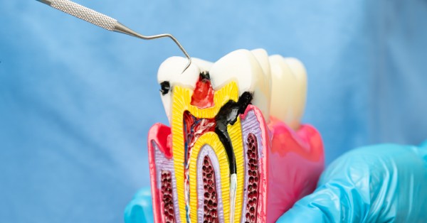 How Long Does the Root Canals Procedure Take?