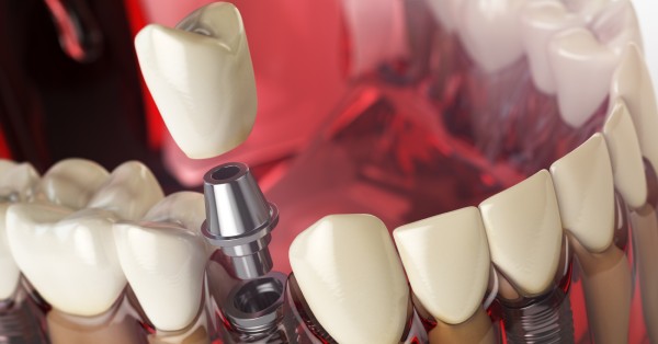 How Long Does It Take to Get a Dental Implant in Garland?