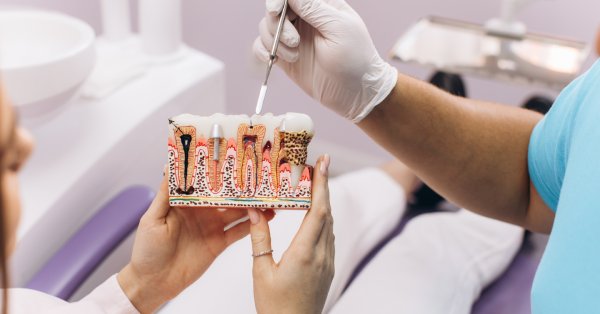 Root canal in Grand Prairie explained with a dental tooth model