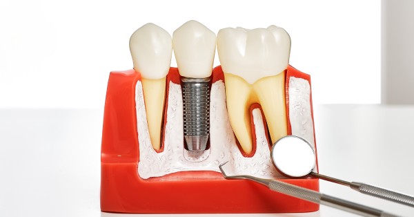 Dental implant and crown shown on a model for dental implants in Grand Prairie