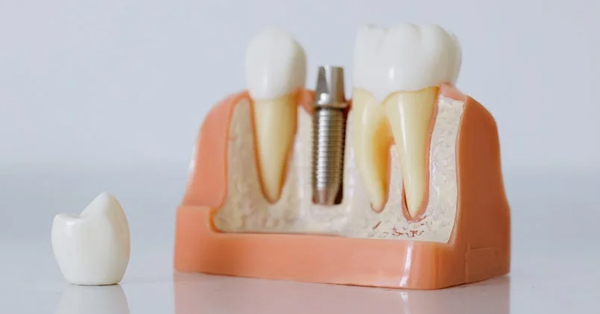 What Does a Dental Implant Look Like?