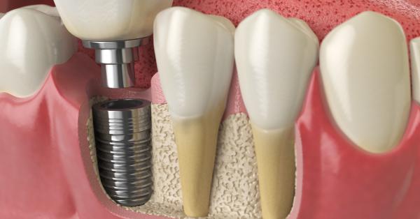 What to Expect After Dental Implants in Grand Prairie