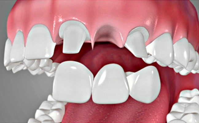 Dental Bridge Treatment for Missing Tooth Dental Bridge Treatment for Missing Tooth