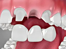 Dental Bridge Dental Bridge