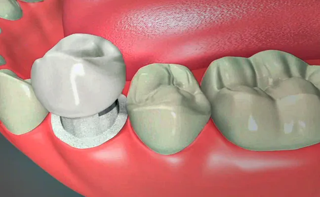 Dental Crown Grand Prairie Dental Crown Grand Prairie