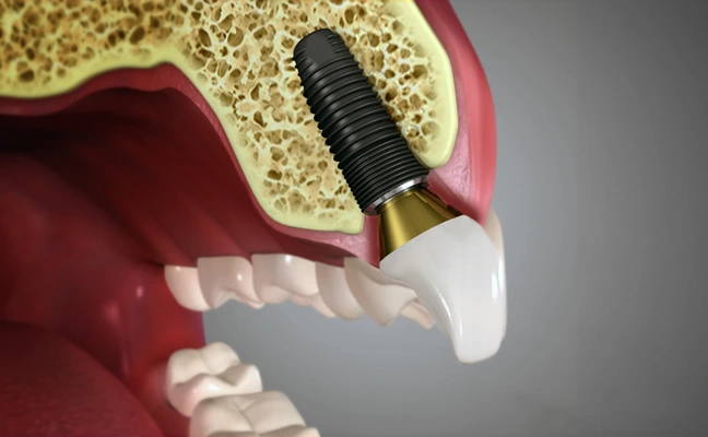 All-on-4 Dental Implants in Grand Prairie All-on-4 Dental Implants in Grand Prairie