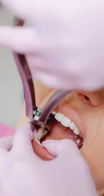 Procedure of Dental Extraction in Grand Prairie Procedure of Dental Extraction in Grand Prairie