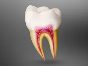 Root Canals