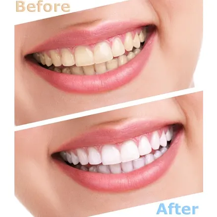 Before & After Images of Teeth Whitening in Grand Prairie Before & After Images of Teeth Whitening in Grand Prairie