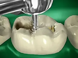 Tooth colored filling Tooth colored filling
