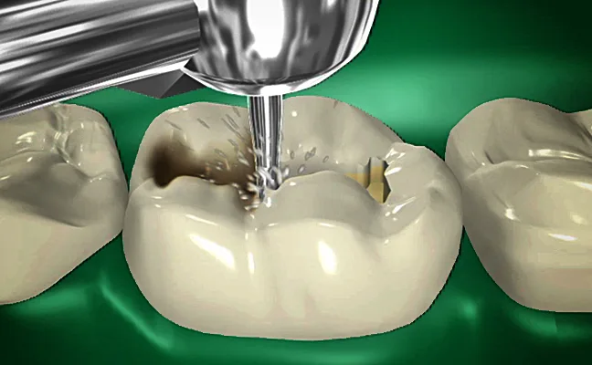 Tooth Colored Filling in Grand Prairie Tooth Colored Filling in Grand Prairie